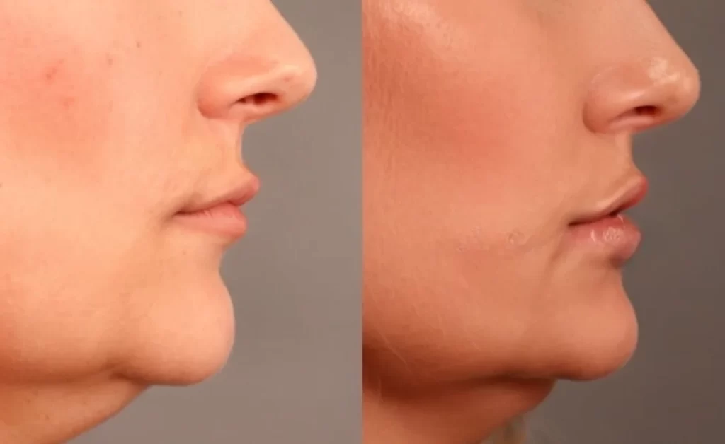 lip flip before after treatment