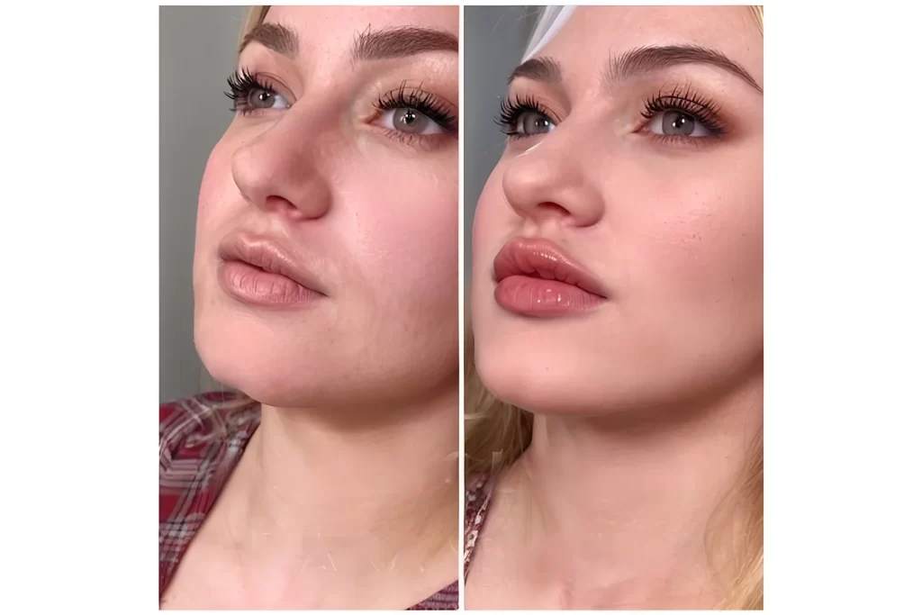 lip flip before and after